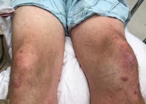 Pete's "not-so-pretty" knees. His left kneecap is "not right."